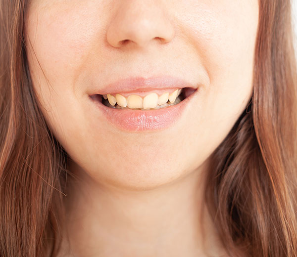 stained and discoloured teeth treatment mount waverley